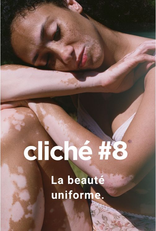 Cliché #8. Le vitiligo.